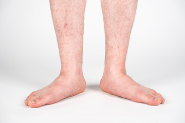 Close up of mans bare foot with strong flat feet also called pes planus or fallen arches.