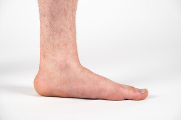 Close up of mans bare foot with strong flat feet also called pes planus or fallen arches. - obrazy, fototapety, plakaty
