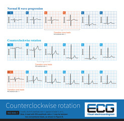 Counterclockwise rotation is a common electrocardiogram phenomenon, which refers to the occurrence of R:S amplitude ratio more than 1 in the right chest lead( V1-V3) .