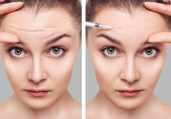 Woman before and after injections to smooth mimic wrinkles.