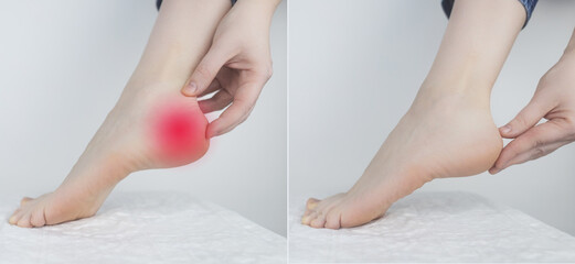 Before and after. Woman suffering from heel pain. Inflammation or sprain of the tendon in the foot,...