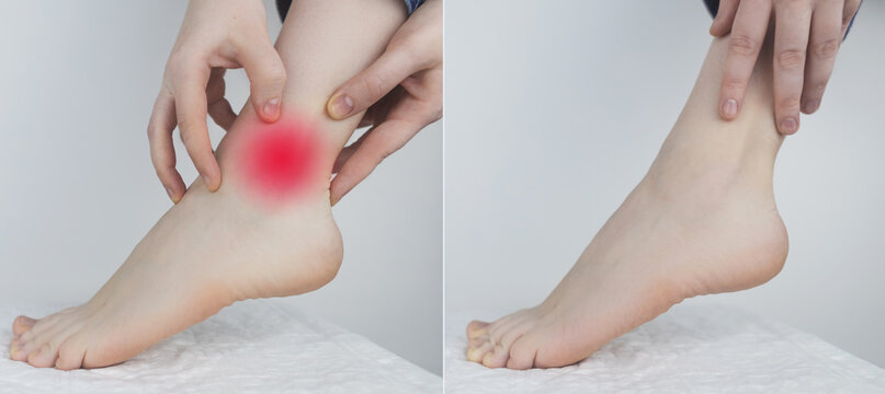 Achilles tendon. Woman show intervertebral hernia, foot dislocation, cartilage damage. Concept material. On one half there is a problem, and on the second - the problem is cured.