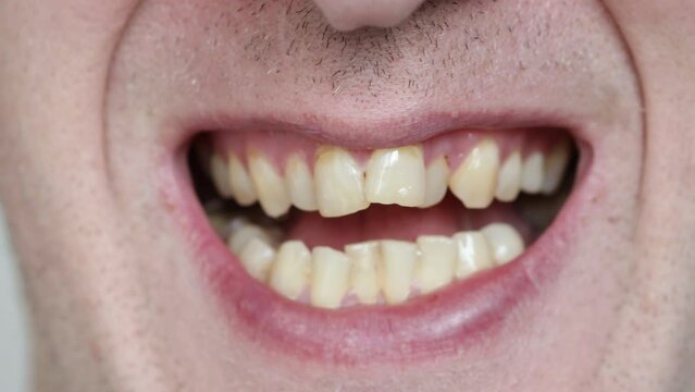 A person with malocclusion. crooked teeth