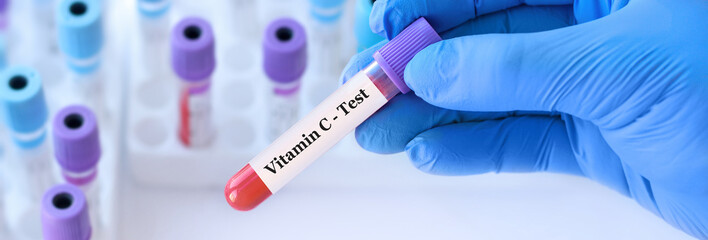 Naklejka premium Doctor holding a test blood sample tube with Vitamin С test on the background of medical test tubes with analyzes.Banner.