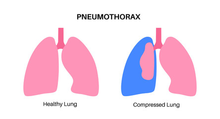 Pneumothorax anatomical poster