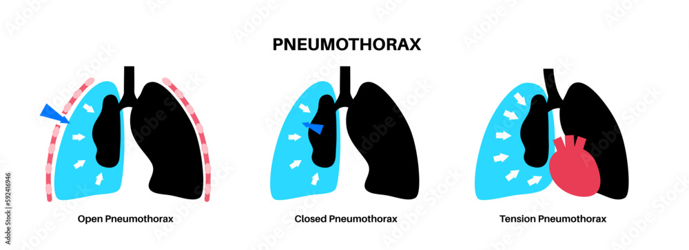 Wall mural Pneumothorax anatomical poster