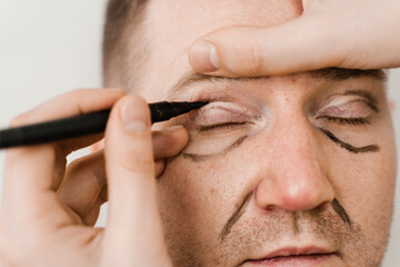 Male blepharoplasty for man markup. Plastic surgeon draws markings on the eyelid before plastic surgery operation for modifying the eye region in medical clinic.