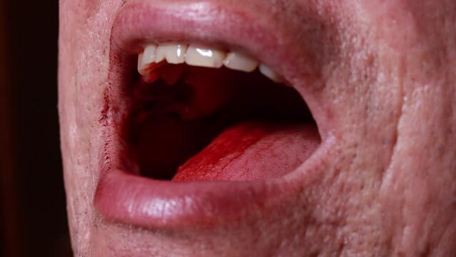 Close up man open mouth, jaw with teeth, detailed sealed bloody tooth after surgery in dental clinic. Tooth extraction treatment. Caries removing, nerve removal canals. Wisdom tooth, severe bleeding
