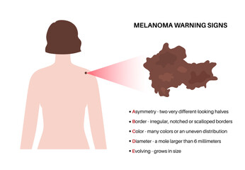 Melanoma warning signs