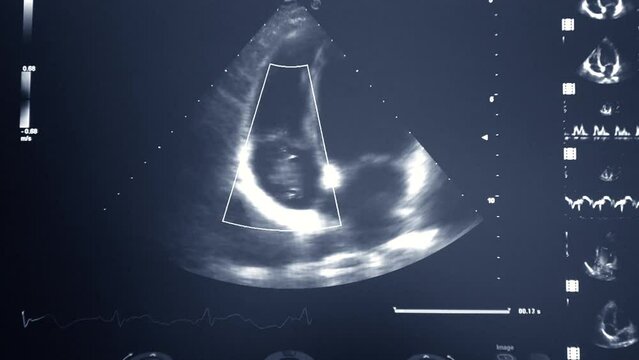 Ultrasound on monitor. Ultrasound image on computer monitor screen close-up. Ultrasound examination. Sonography sonogram. Ultrasonography ultrasonic. Monitoring diagnostic medical healthcare system