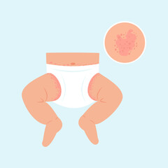 Baby with diaper rash, skin rash, allergy. Redness of skin in children.Dermatological problems. Vector illustration