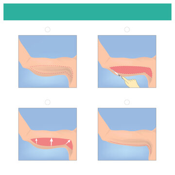 Brachioplasty Arm Lift Procedure. Medical Process Excess Skin And Fat Are Removed From Between The Armpit And Elbow. The Remaining Skin Is Placed Back Over The Newly Repositioned Contours..