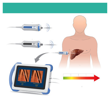 Liver Stiffness Measurement. Measuring tissue liver stiffness in patients by using the reflection sound waves for diagnose of cirrhosis.