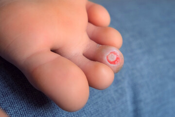 Wound of removed wart after laser removal on patient boy's foot toe, closeup view. One day surgery concept. Removed verruca papilloma on leg. One day surgery concept. Sore, wound after operation.