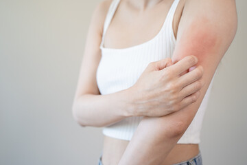 Sensitive skin allergic concept, Woman itching on her arm have a red rash from allergy symptom and from scratching. - obrazy, fototapety, plakaty