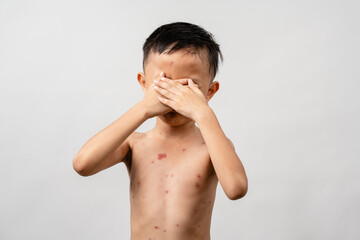 A 7 year old Asian boy has chickenpox. pimples on the body of child with chickenpox
