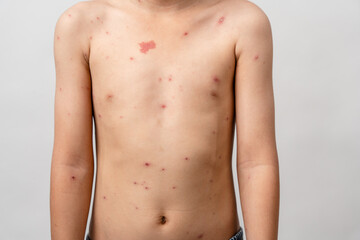 Fototapeta premium A 7 year old Asian boy has chickenpox. pimples on the body of child with chickenpox