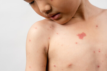 A 7 year old Asian boy has chickenpox. pimples on the body of child with chickenpox