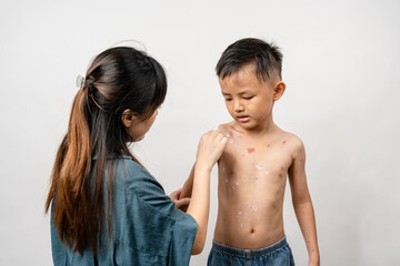 A mother is applying itching ointment to him 7 year old Asian boy suffering from chickenpox....