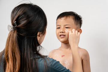 A mother is applying itching ointment to him 7 year old Asian boy suffering from chickenpox. pimples on the body of child with chickenpox