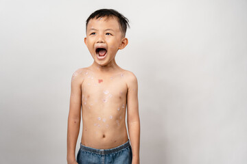 A 7 year old Asian boy has chickenpox. pimples on the body of child with chickenpox