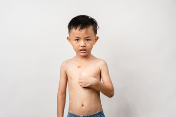 A 7 year old Asian boy has chickenpox. pimples on the body of child with chickenpox