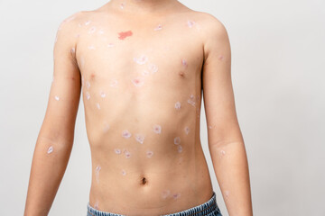 Fototapeta na wymiar A 7 year old Asian boy has chickenpox. pimples on the body of child with chickenpox