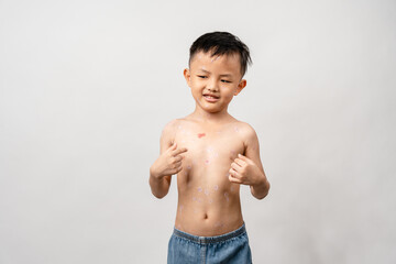 A 7 year old Asian boy has chickenpox. pimples on the body of child with chickenpox