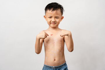 A 7 year old Asian boy has chickenpox. pimples on the body of child with chickenpox