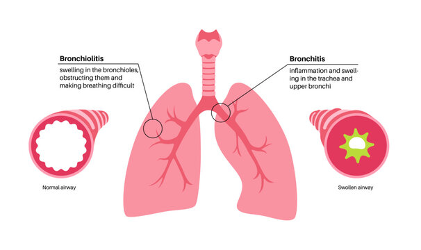 Bronchitis and bronchiolitis