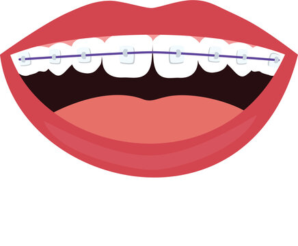 Teeth with braces on white background. Braces Corrective Orthodontics. Smiling mouth with braces isolated  vector illustration