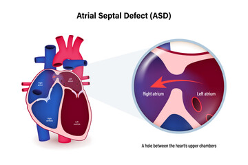 Atrial septal defect (ASD) vector. Congenital heart defect. - obrazy, fototapety, plakaty