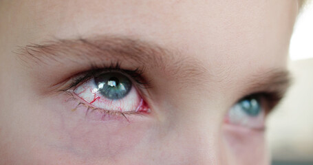 Red Eye Vessels Irritation And Allergy