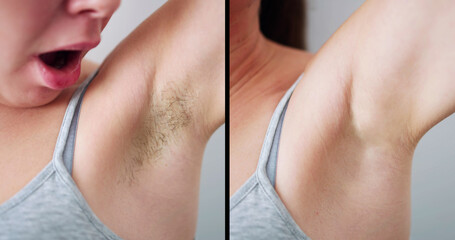 Before And After Concept Of Woman's Underarm Hair Removal