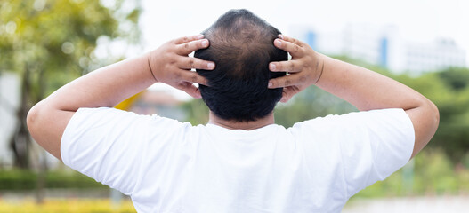 Middle aged asian man with early stage baldness and hair loss problem