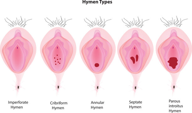defloration before after Laryngopedia