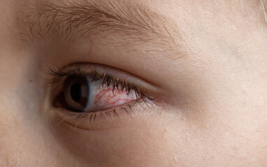 A young child with spoiled eyes suffers from conjunctivitis.Close up of a severe bloodshot eye.