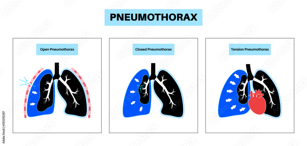 Canvas Prints Pneumothorax anatomical poster