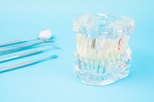 The Human jaw or Acrylic dentures model with implants and dental tools on blue background.