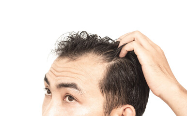 Fototapeta premium Closeup Young man serious hair loss problem with white backgroun for health care medical and shampoo product concept, selective focus