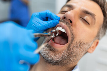 Surgeon removing the tooth. Dentist using surgical pliers to remove a tooth in clinic