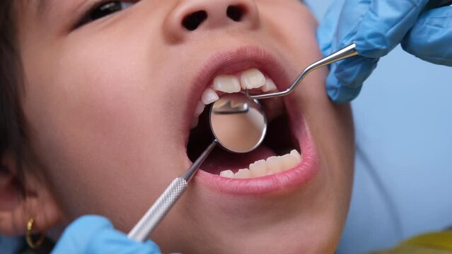 Close-up inside the oral cavity of a healthy child with beautiful rows of baby teeth. Young girl opens mouth revealing upper and lower teeth, hard palate, soft palate, dental and oral health checkup.