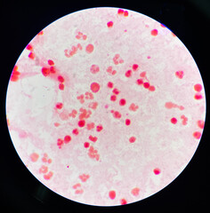 Neutrophil in synovial fluid inframatory cells.