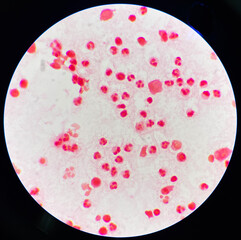 Neutrophil in synovial fluid inframatory cells.