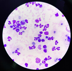 Neutrophil in synovial fluid inframatory cells.