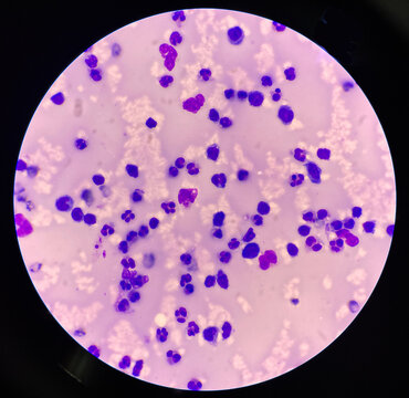 Neutrophil in synovial fluid inframatory cells.