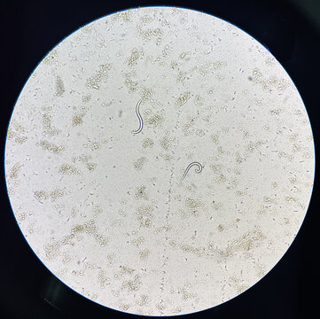 Strongyloides stercolari larva moving in fresh stool.