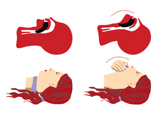 Kopf &uuml;berstrecken um die Atemwege freizumachen