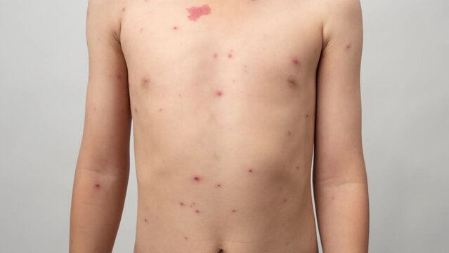 A 7 year old Asian boy has chickenpox. pimples on the body of child with chickenpox