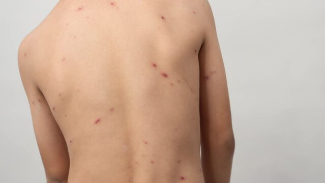 A 7 year old Asian boy has chickenpox. pimples on the body of child with chickenpox